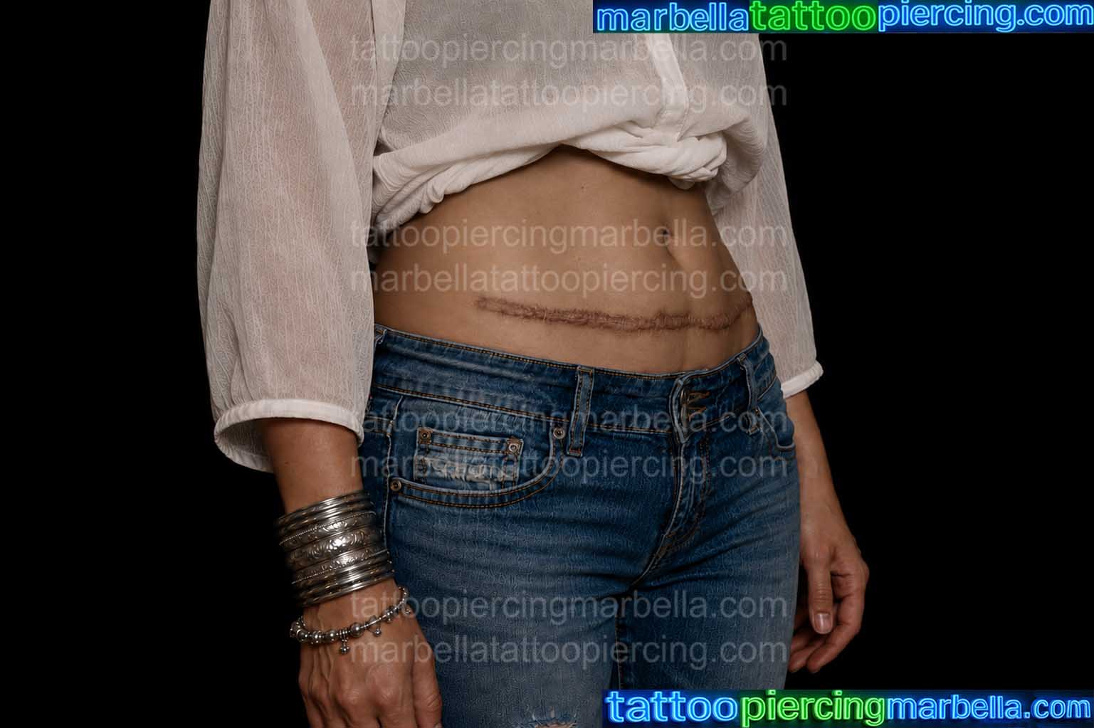 ORIGINAL SUPER KELOID SCAR