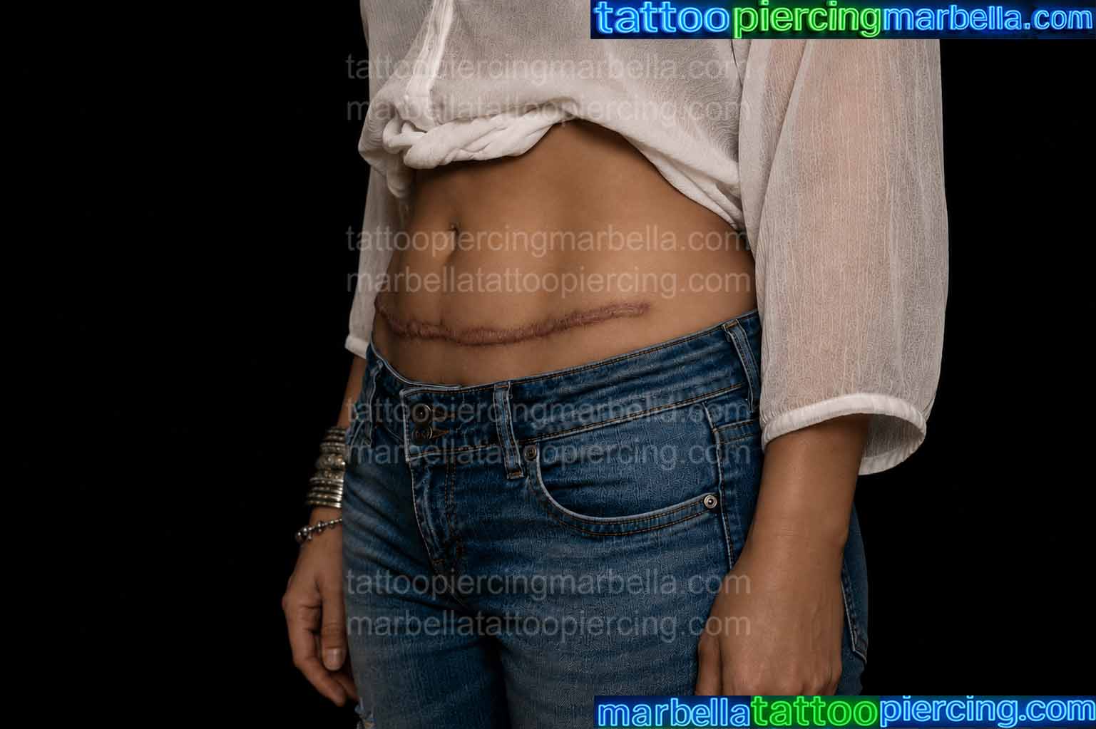 ORIGINAL SUPER KELOID SCAR